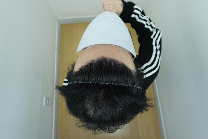 This is the 210th day of mass hair transplantation at Jarada Clinic.