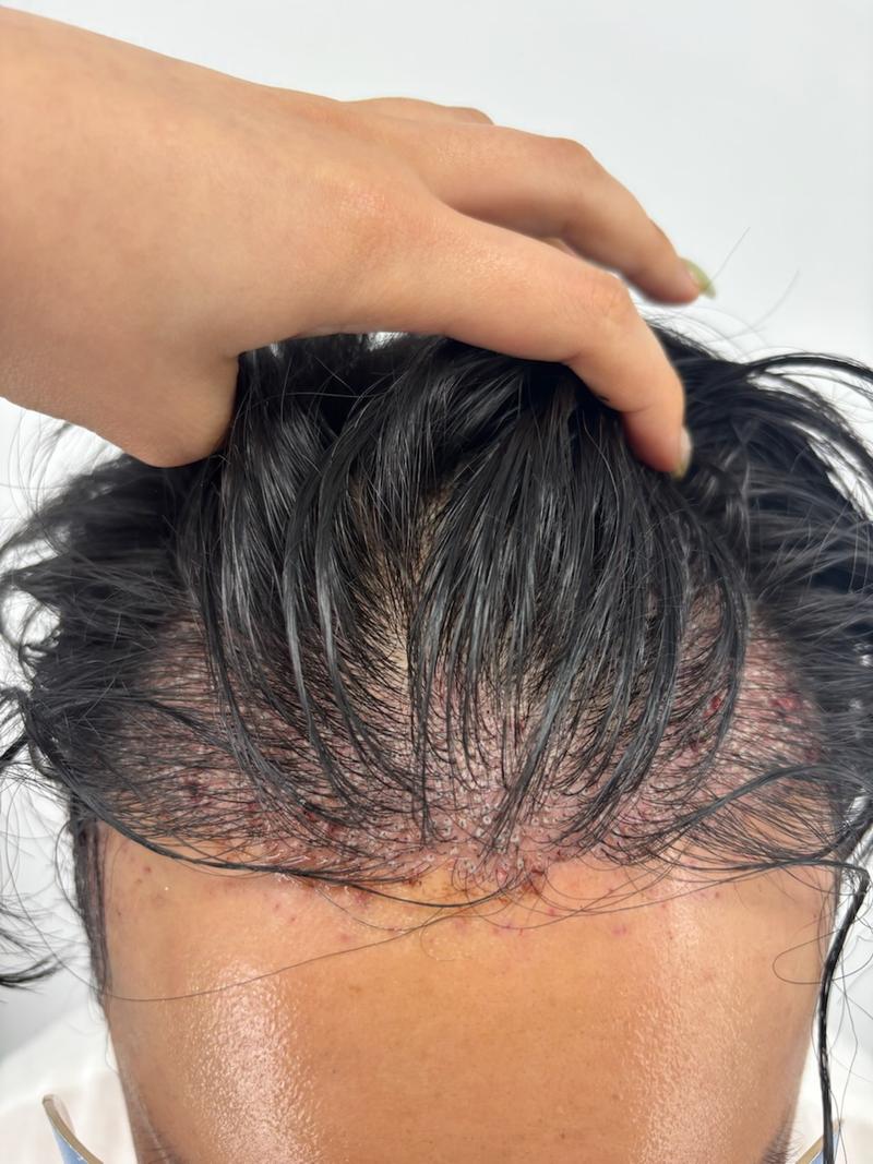 뉴헤어 2일차 비절개 모발이식(1400모낭) 후기 입니다
