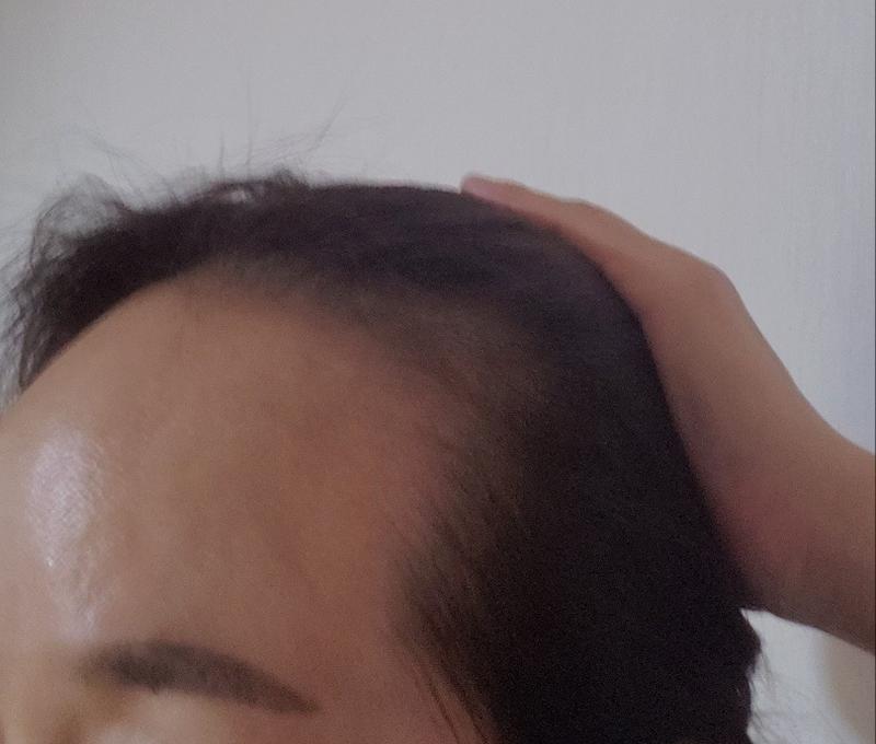 50代の女性はげている額の毛髪移植手術から1年が経ちました···.
