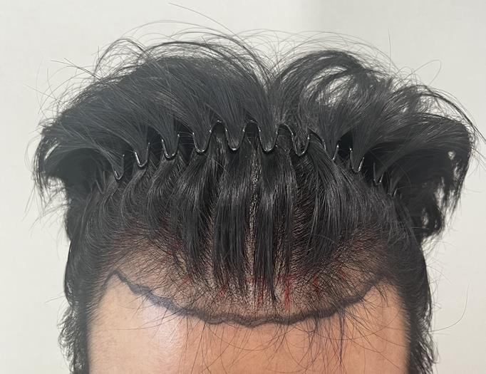 M자 모발이식 1년 경과 너무나도 만족스러운 리얼 후기