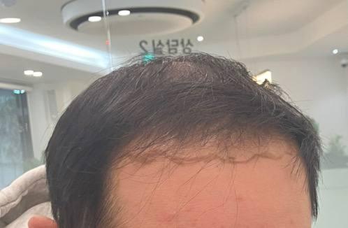 モディヘアプラント 頭頂部 幹細胞治療 20回、毛髪移植 4500毛 レビューです