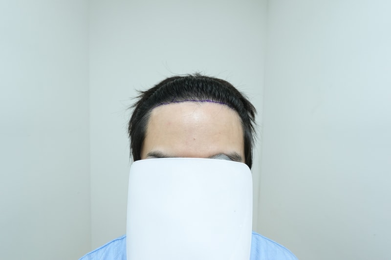 자라다의원 모발이식 2일차 후기