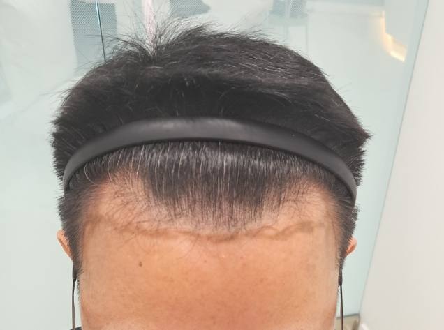 모디헤어 모발이식 줄기세포치료한 지 6달 지났습니다.