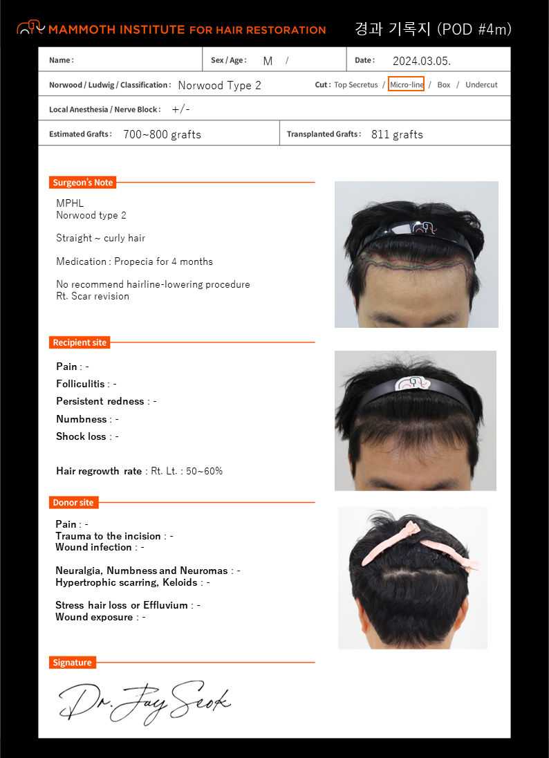 [Apgujeong mammoth M-shaped non-cut hair transplant after 4 months]