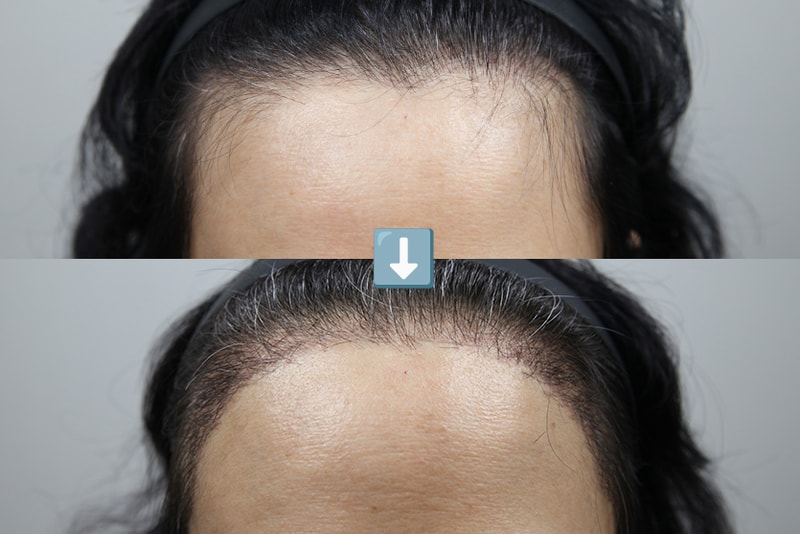 각진 헤어라인, 둥글게 헤어라인 교정 모나라 김대우 원장님에게 1개월