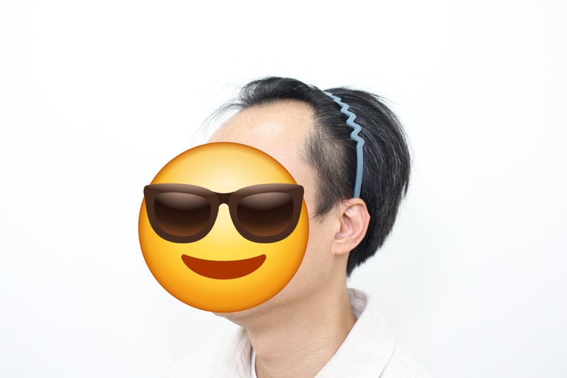 모프로의원, ★신사역★, 헤어라인, 10일차 ( 남자 M자 )