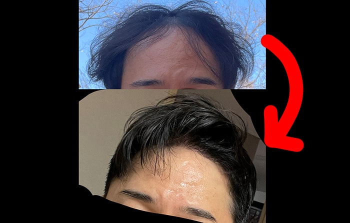 6개월 후기. 모발이식은 제 2의 인생입니다