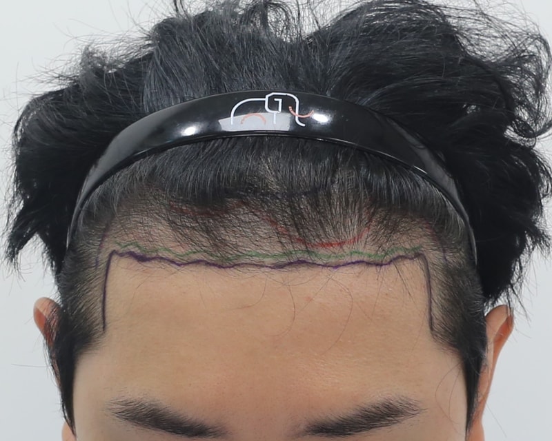 狎鴎亭 マンモスヘアライン 非切開 スリット 毛髪移植 4ヶ月後記
