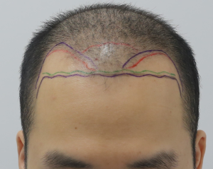 狎鴎亭マンモスヘアライン、ダイヤモンドスリット非切開毛髪移植(M字~前頭部)4ヶ月目経過