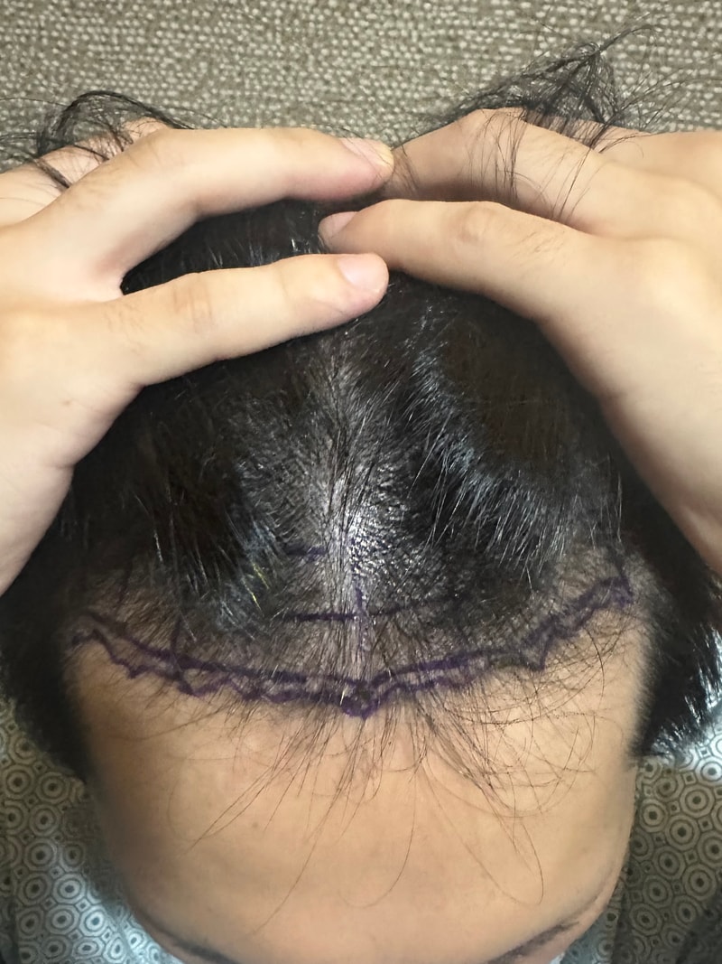 [New Hair Hair Plastic Surgery] Review of 1,500 hair follicles on the 5th day of non-cut hair transplantation