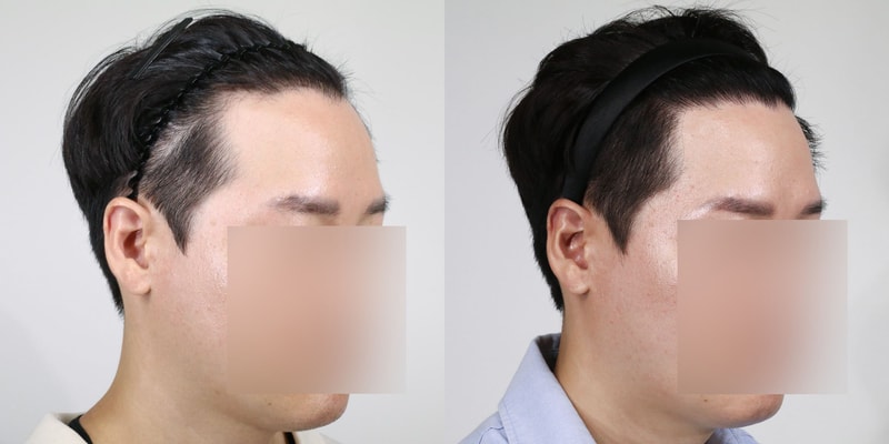 압구정 모우림의원 2년차 후기 ( 사진첨부 )