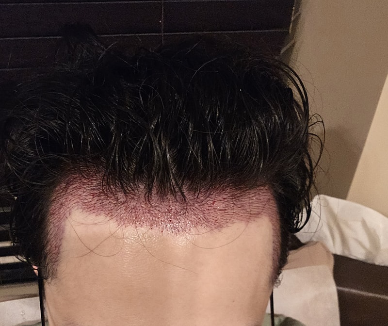 I got a hair transplant from Apgujeong Mo Woo-rim clinic