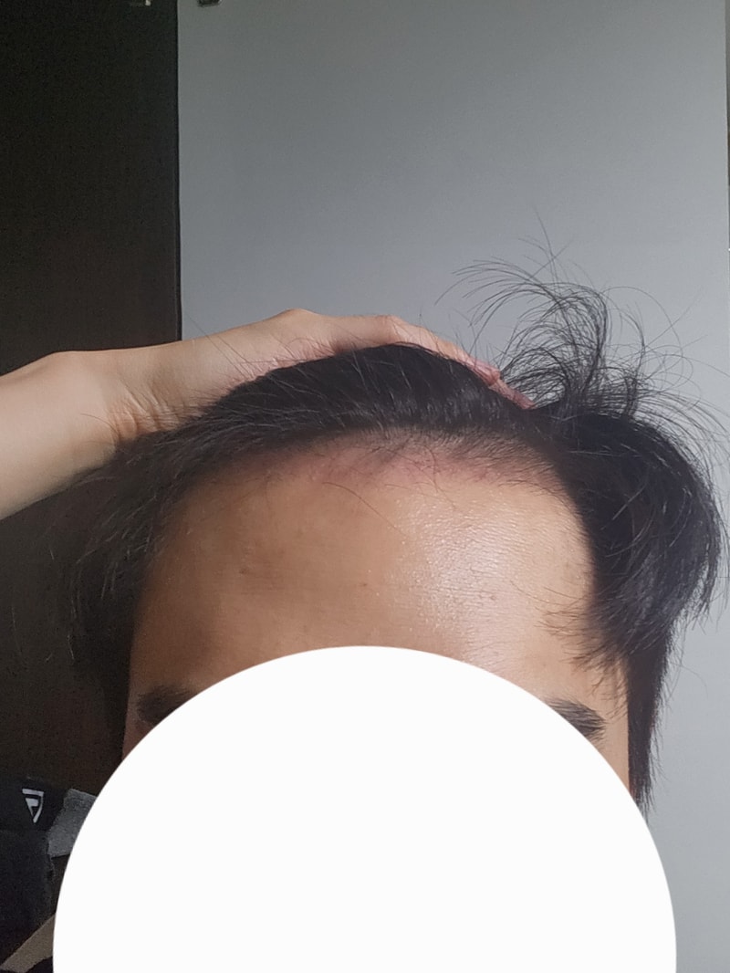 모발이식 3개월차 솔직 후기