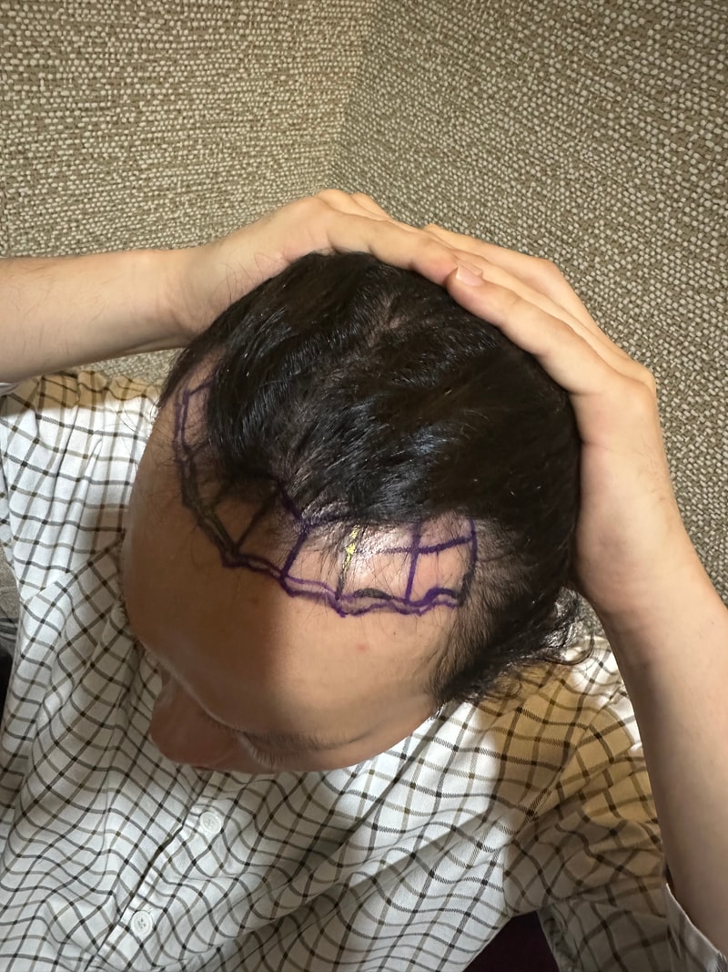 뉴헤어 수술다음날 비절개 3200모 모발이식 후기 입니다.