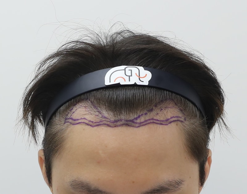 狎鴎亭 マンモスヘアライン 医院 M字脱毛 非切開 毛髪移植 12ヶ月目 経過チェック レビュー
