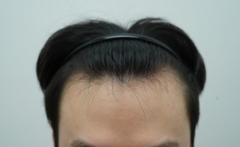 [Yeon Se-mona Clinic] A review of the Hair Transplant of male M hair loss in his 20s.