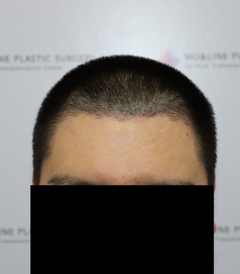[MON-LINE] Review of Hair Transplant Reoperation Week 2