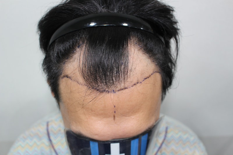 모더함의원, 4,000모 이상) 남성 깊은 엠자 + 앞밀도 + 전두부 사이 비절개 시술 당일, 다음날 샴푸 이후 입니다:)
