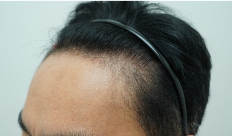 [Yeon Se-mona clinic] Please look at the 5th week of M-shaped Hair Transplant.
