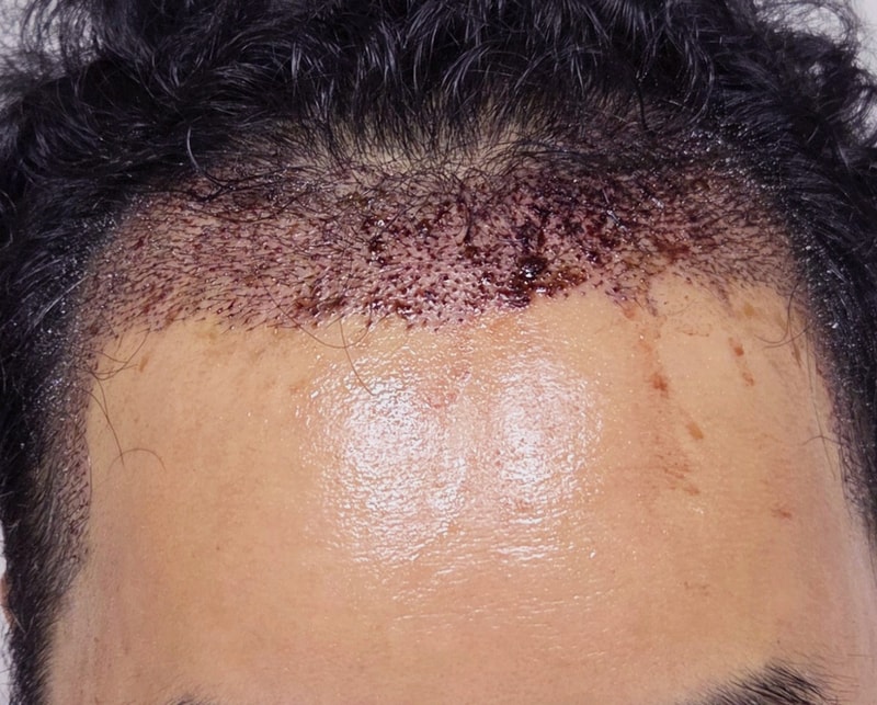 [Apgujeong Mo Woo-rim Clinic] Review of the second day of 4700 hair incision