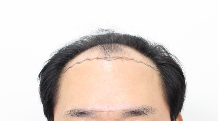 Late Day 15 of Hair Transplant 5300 hair incision Mopro Clinic