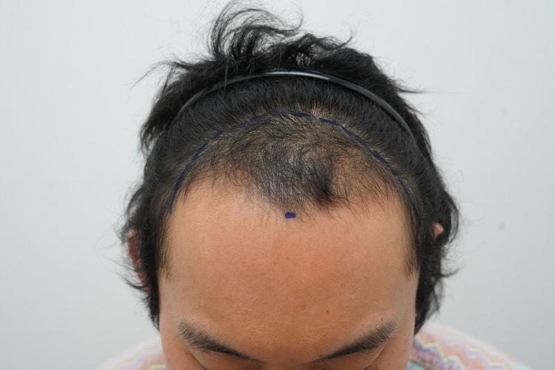 [延世大学MONA医院] 前头 脱毛 2204 毛囊 非接缝毛发移植后记