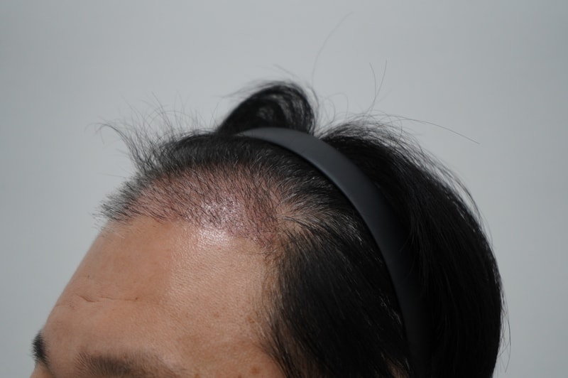 Three weeks after Hair Transplant surgery.