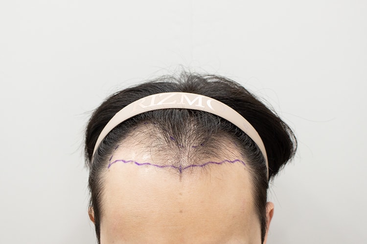 대전 리즈모의원 남자 모발이식 2주차 후기