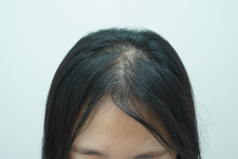 [연세모나의원] 40대 여자 강남역 근처 모발병원에서 모발이식 받고 지금 1년 다되어갑니다