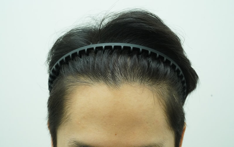 [연세모나의원]수술 직후 → 12개월차 후기 공유합니다