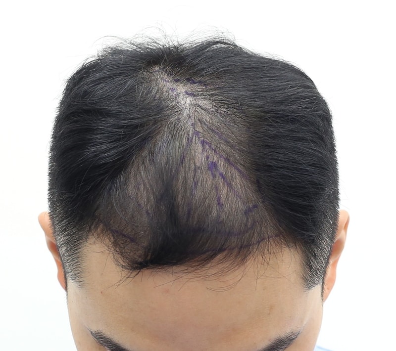 狎鴎亭マンモスヘアラインクリニック拡散性薄毛前頭部、頭頂部植毛手術当日体験談