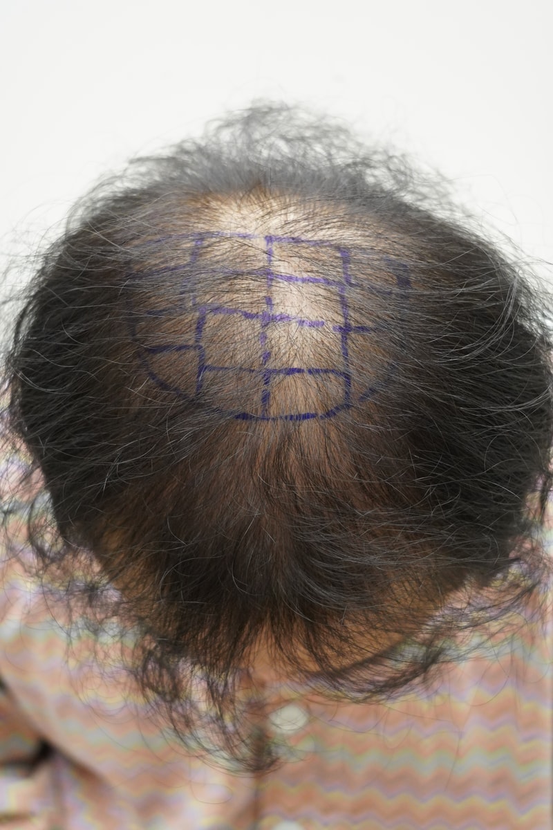 [Yeon Se-mona clinic] A review of male top Hair Transplant.