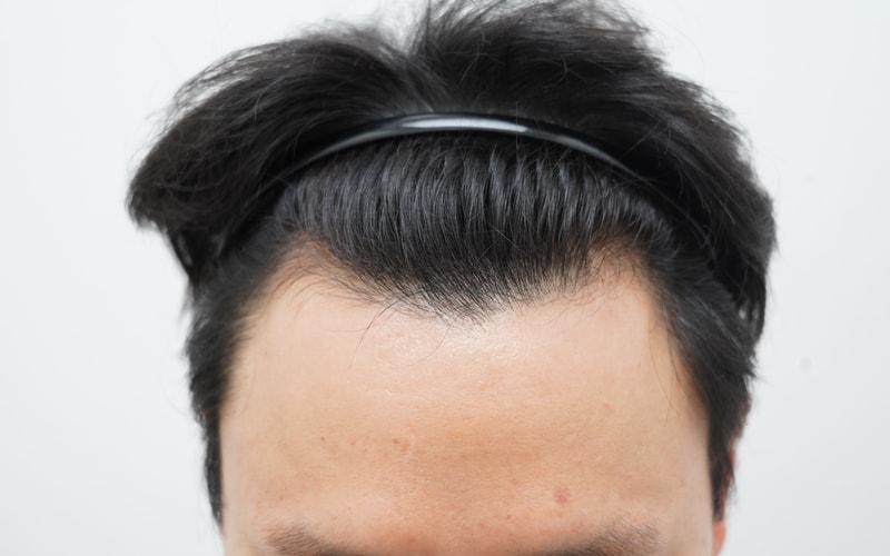 [Yeon Semona clinic] CEO Choi Sang-young's review of non-cut hair transplant