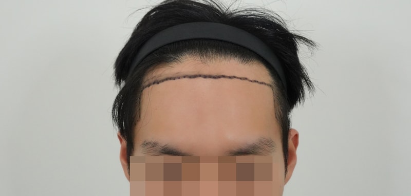 용닥터의원 남자모발이식 3400모 1년 후기 적어봐요