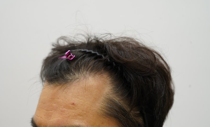 [Yeon Semona Clinic] Review of the Hair Transplant of m-shaped hair loss 1455 hair loss.