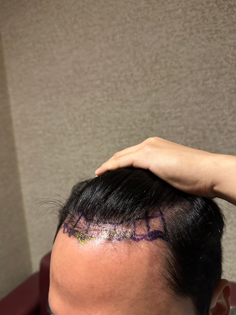 뉴헤어 4일차 비절개 모발이식 후기 1500모낭 했습니다~