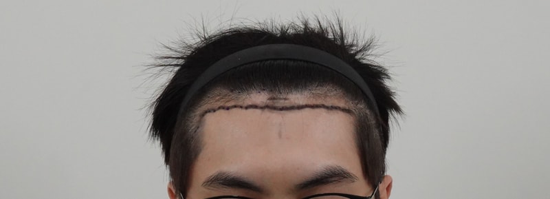 1年产 2000毛非切开术毛发移植短后记