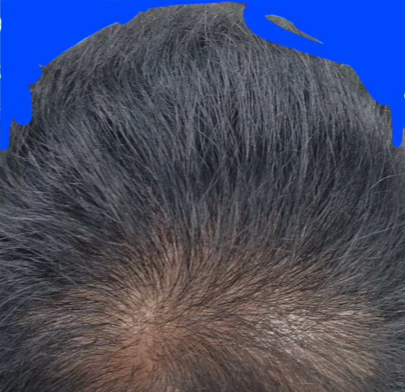 手术经过 5 个月左右，大邱The Black