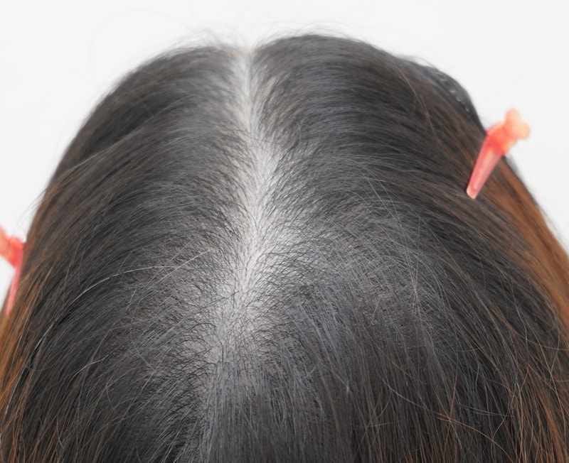 [연세모나의원]여자 가르마 탈모 모발이식 후기 사진있어욤