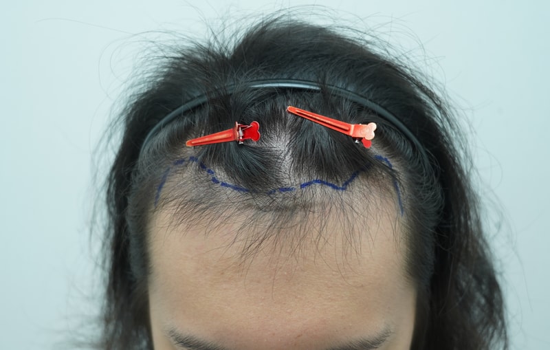 [Yeonse-mona clinic] Review of 5,300 mo in Hair Transplant.