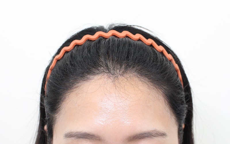 헤어라인 비절개 2300모 6개월 경과입니다!