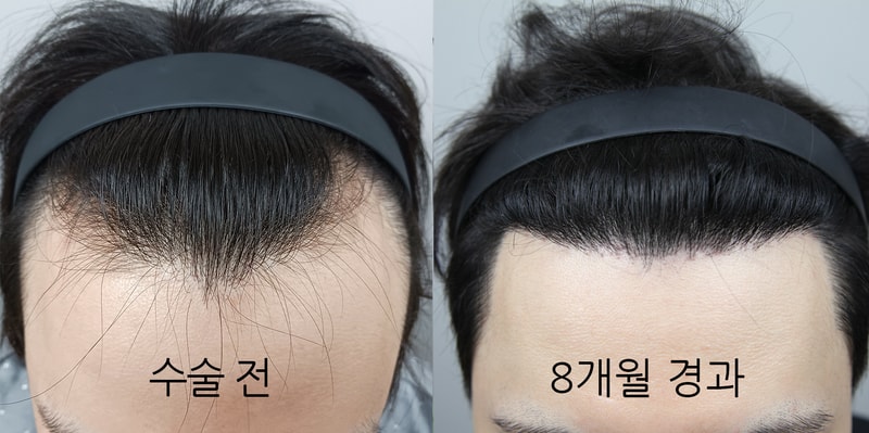 모나라 모발이식 8개월 대박났습니다ㅎㅎㅎ