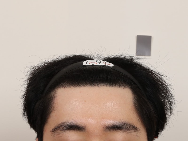 부산모발이식 슬릿 방식 맘모스 M자 1년 경과 후기