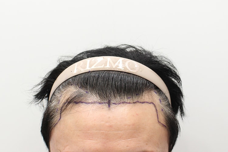 드디어 대전 리즈모에서 비절개 모발이식 받고 2주차 후기 남깁니다