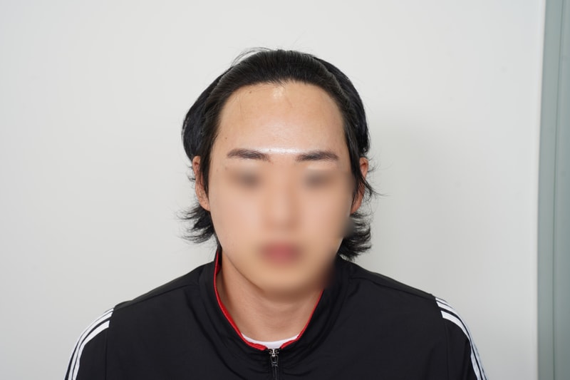 [바람부는날에도] 이마축소수술 한달차 후기