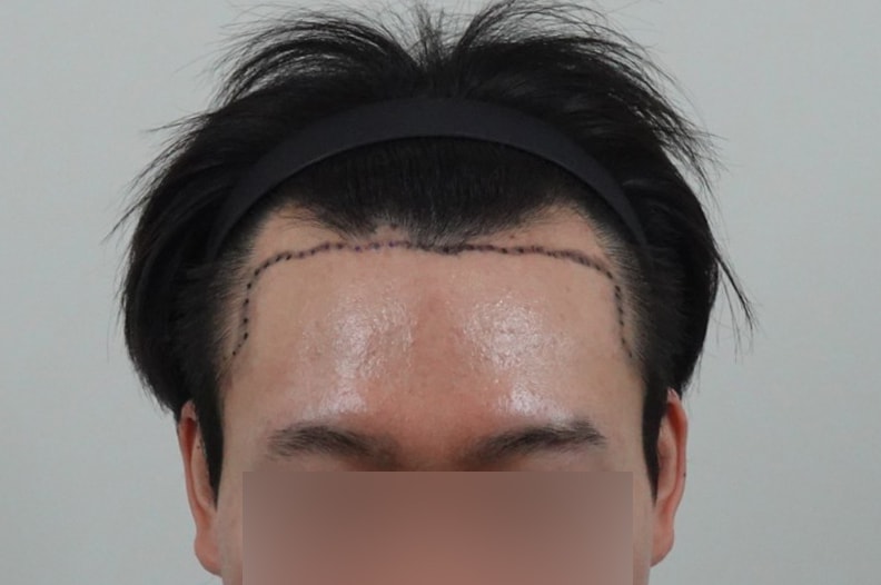 남자모발이식 2000모 1년차