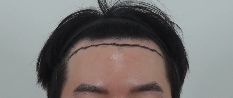 용닥터의원 m자헤어라인 라인컷 2500모 후기