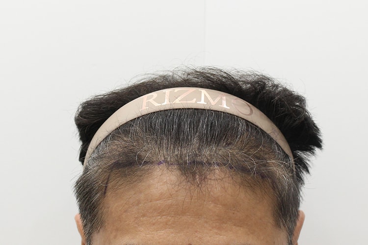 고민하던 모발이식 대전 리즈모에서 해결했습니다^^