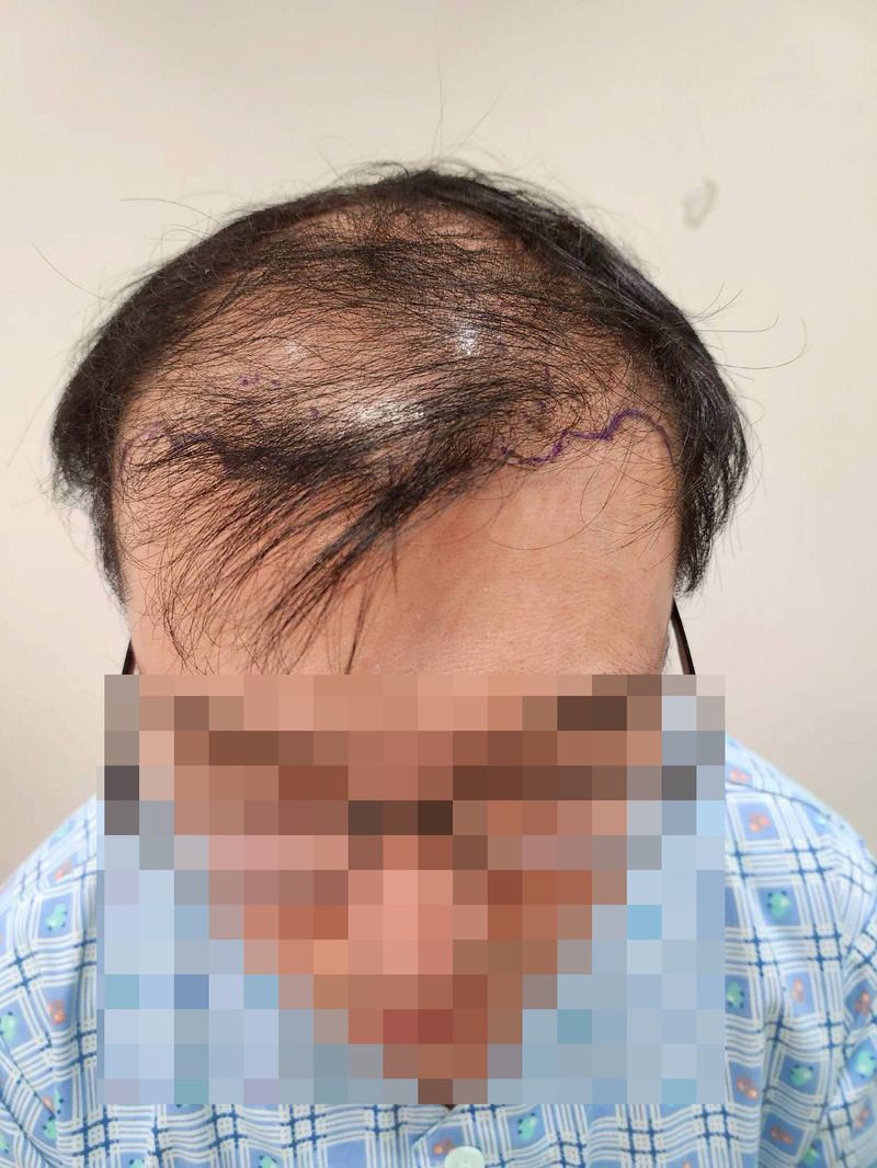 강남역 두드림에서 모발이식 6개월후