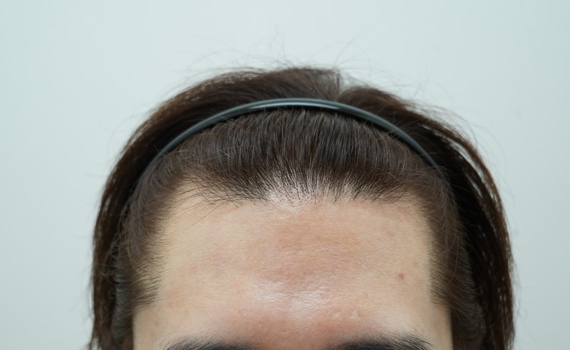 [연세모나의원]비절개 1666모낭(약4000모 m자 및 가르마 수술)